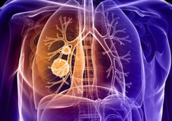 Akciğer kanseri nedir ve nasıl tedavi edilir?